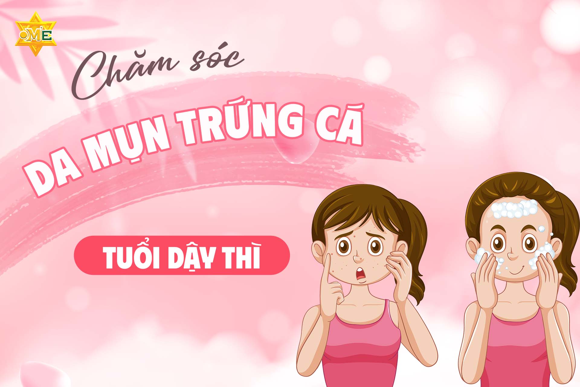 Chăm sóc da mụn trứng cá tuổi dậy thì